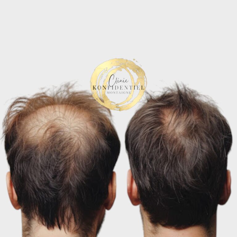 VERTEX | TONSURE résultat 1 an